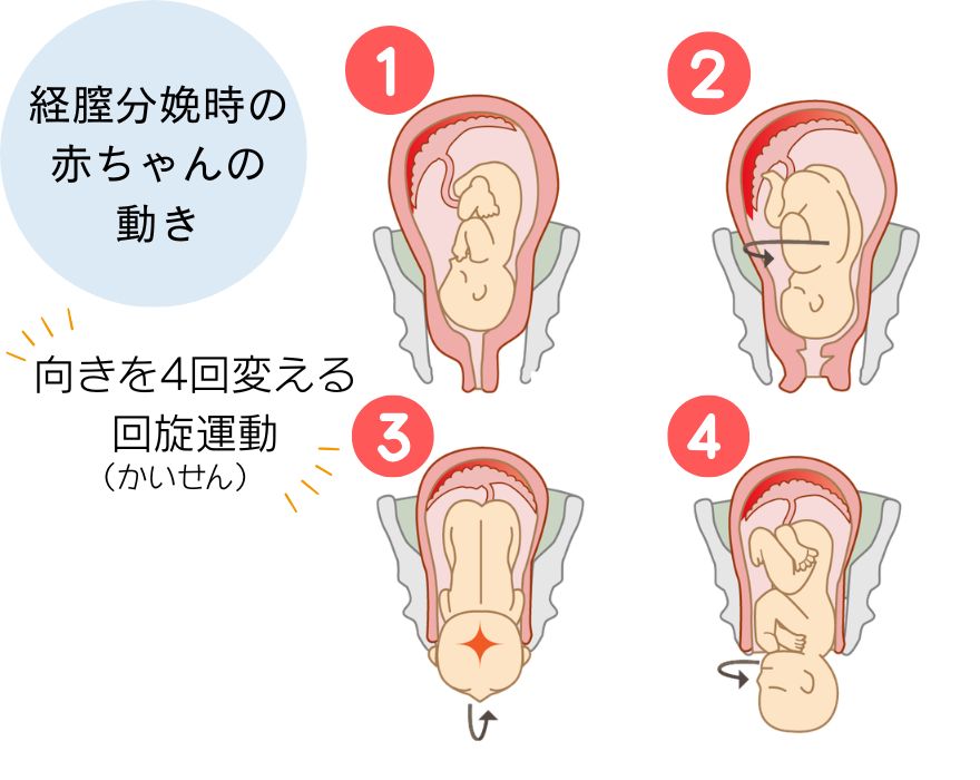 経膣分娩時の 赤ちゃんの 動き　骨盤底筋にダメージが